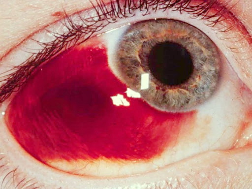 เส้นเลือดฝอยในตาแตก อันตรายต่อดวงตา
